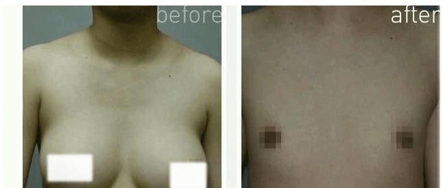 의사를 당황시킨 여유증 환자
