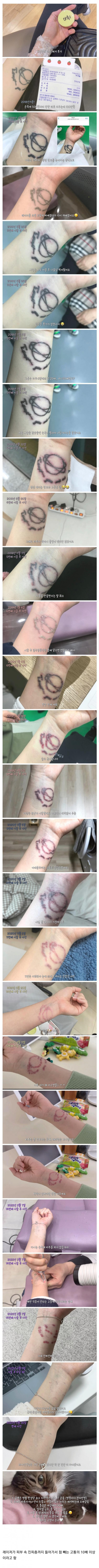 타투 제거 후기