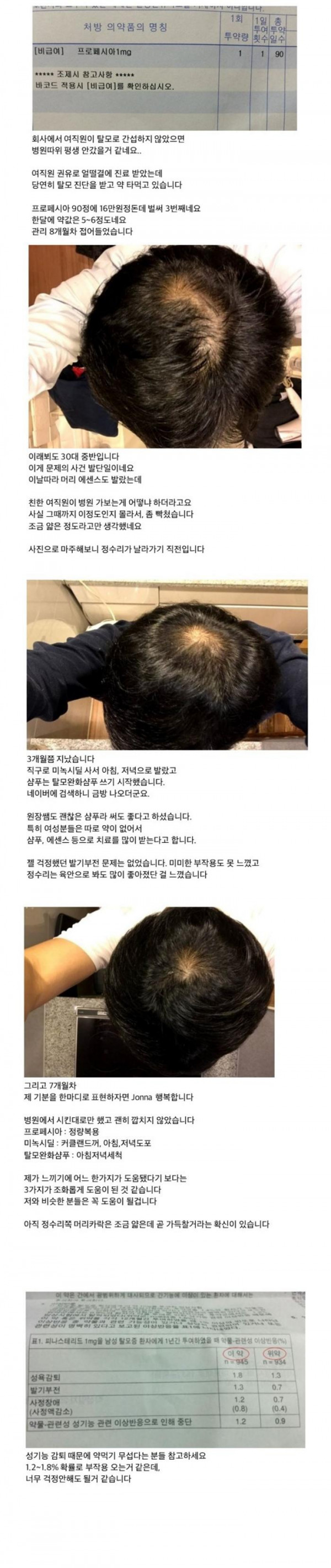 탈모약 먹고 성공한 케이스